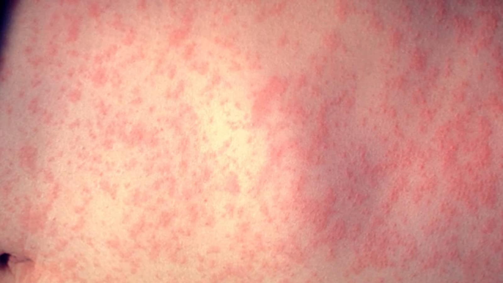 14379247 Measles Img Web