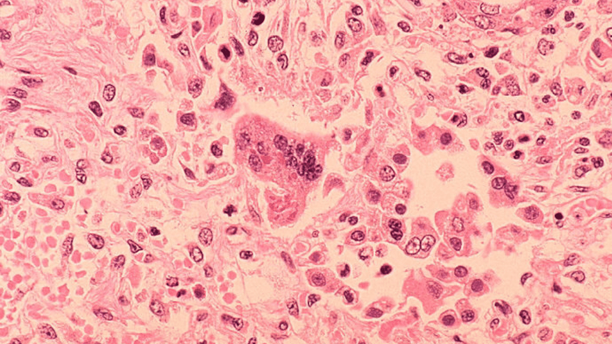 Measles Getty